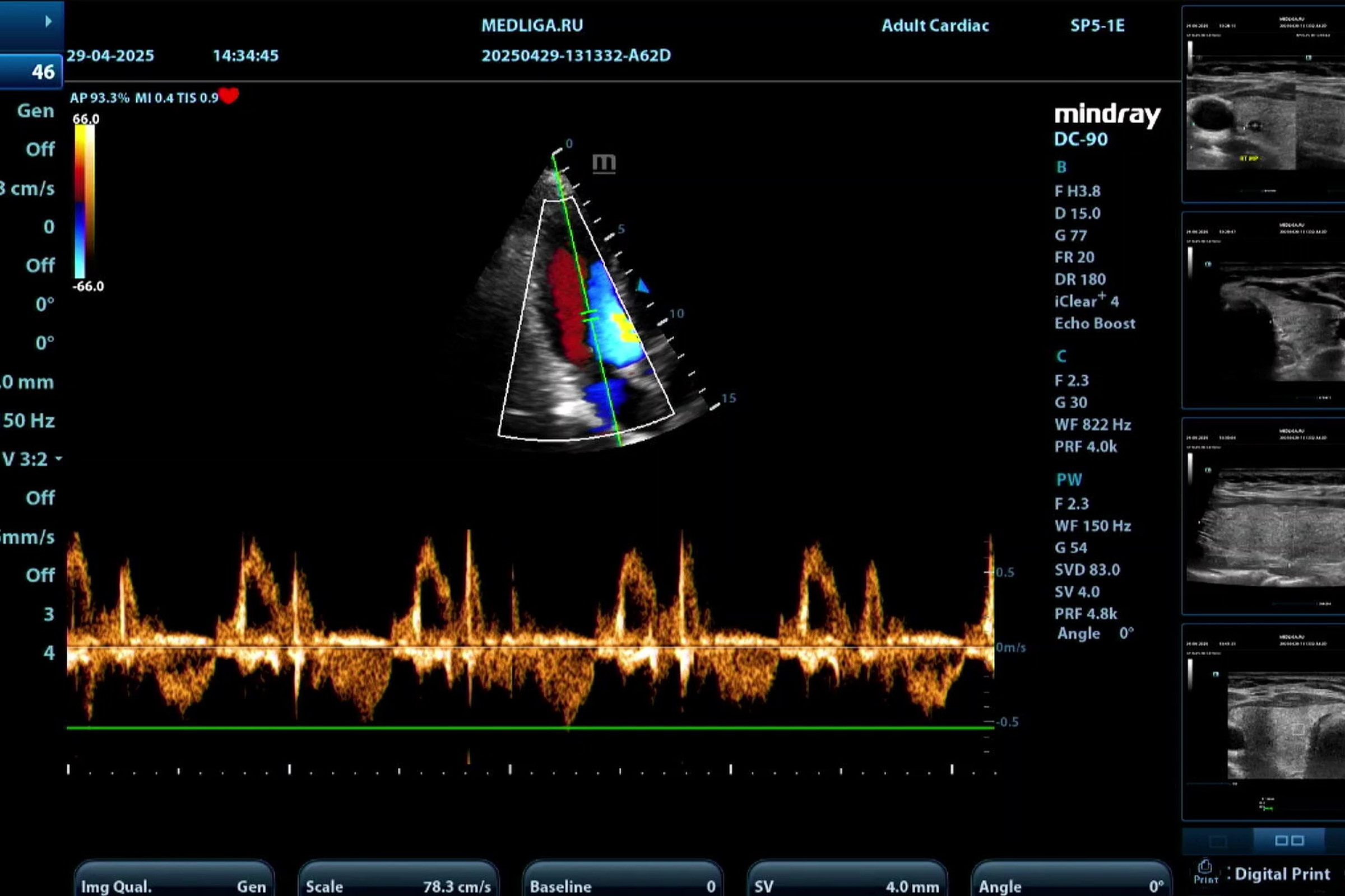 Как улучшить визуализацию на Mindray DC-90: мастер-класс для врачей УЗИ
